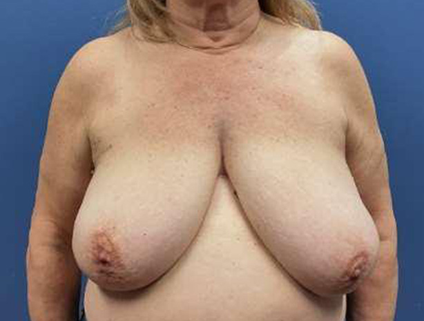 Before Image: Breast Reduction - front