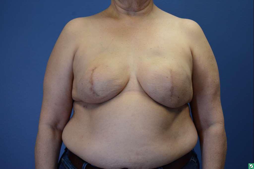 Before Image: Bilateral Tissue Expander Removal and DIEP Flap - front