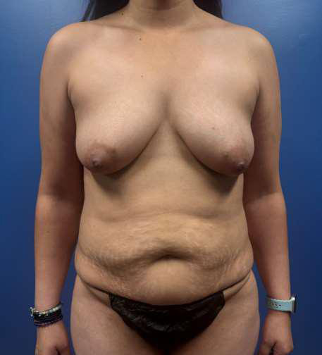Before Image: Bilateral Mastectomy and DIEP Flap - front