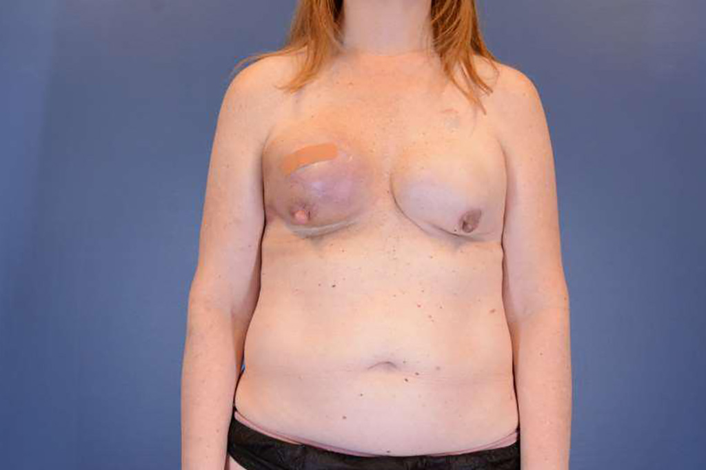 Before Image: Breast Reconstruction - front