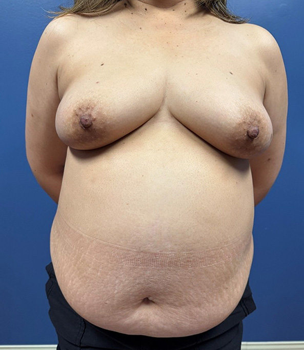 Before Image: Breast Reconstruction – DIEP Flap - front