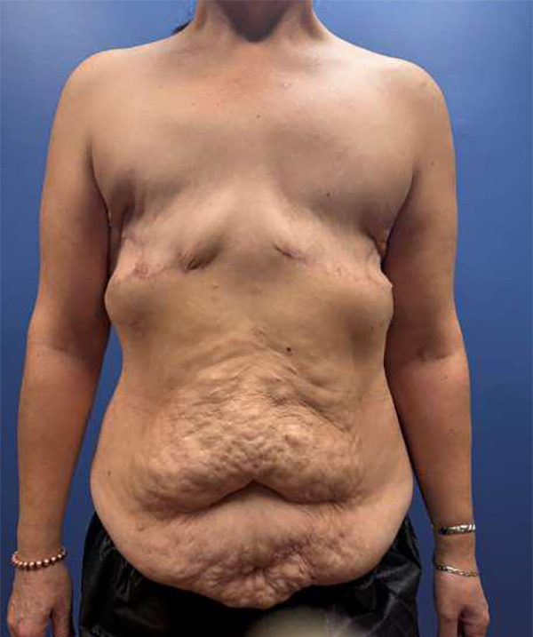 Before Image: Mastectomy Reconstruction with DIEP Flap - front