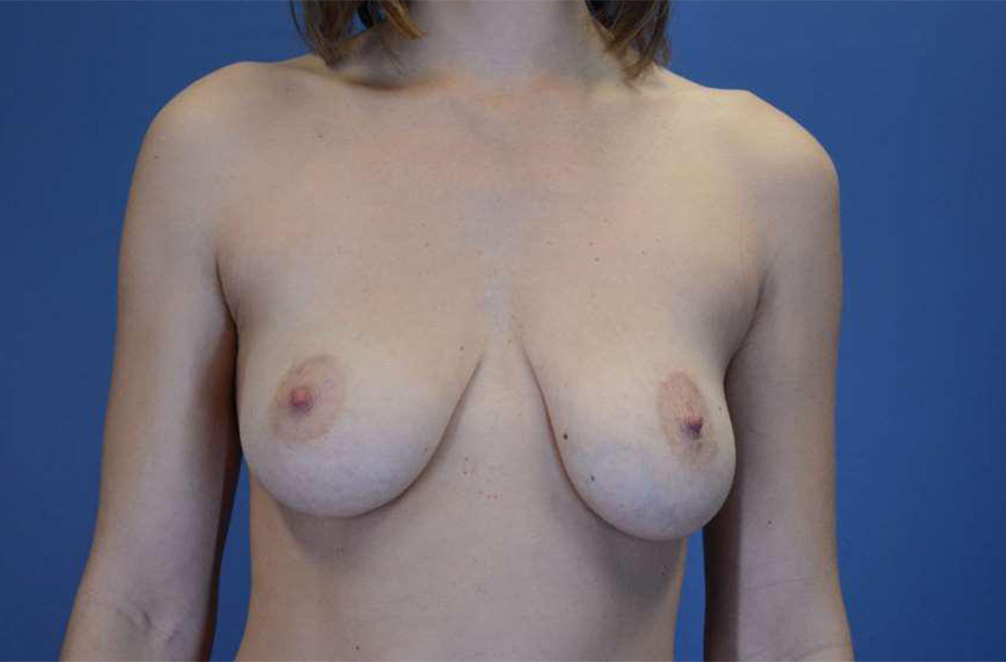 Before Image: Mastopexy Augmentation with Silicone Implants - front