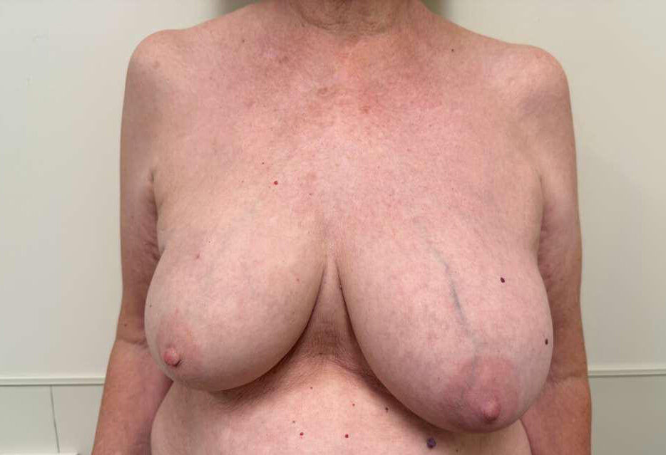 Before Image: Right Mastectomy and Tissue Expander - front