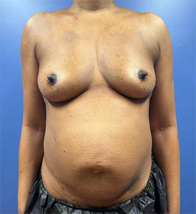 Before Image: Nipple-Sparing Mastectomy and DIEP Flap - front