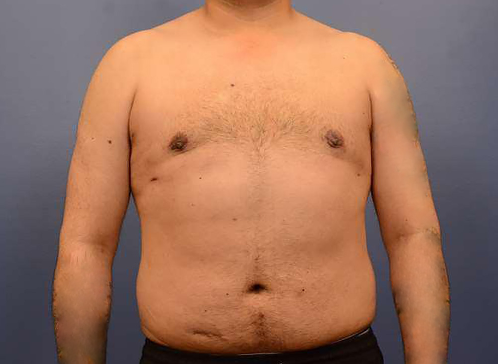 After Image: Ultrasound Liposuction and Gynecomastia Excision - front