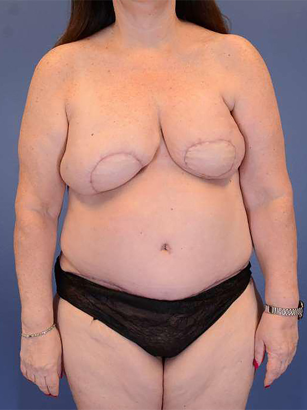 After Image: Bilateral Mastectomy and DIEP Flap - front