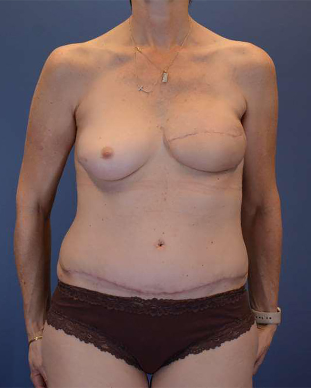 After Image: Left Breast Mastectomy and DIEP Flap - front