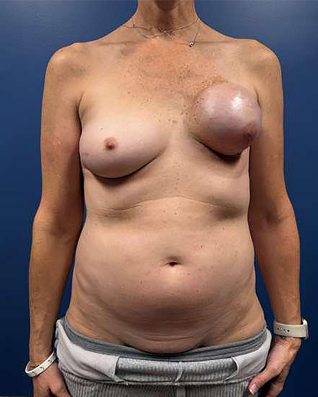Before Image: Left Breast Mastectomy and DIEP Flap - front