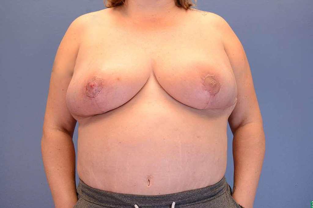 After Image: Oncoplastic Reduction, Lumpectomy and Free Nipple Graft - front