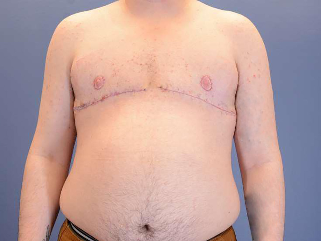 After Image: Top Surgery with Free Nipple Grafting - front