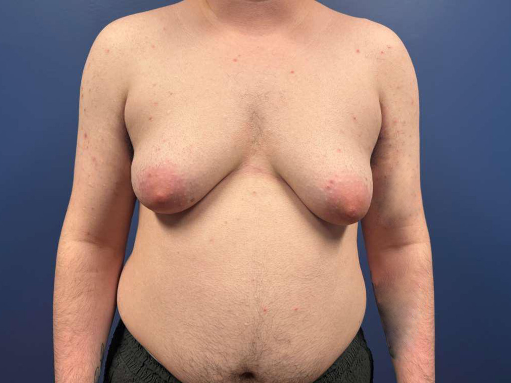 Before Image: Top Surgery with Free Nipple Grafting - front